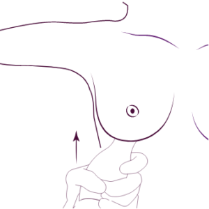 Preserve Breast Augmentation Dubai