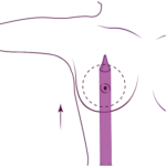 Preserve breast augmentation