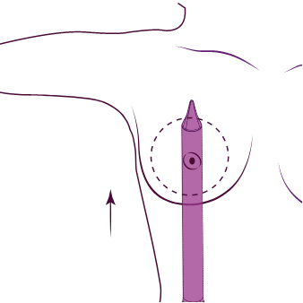 Preserve breast augmentation