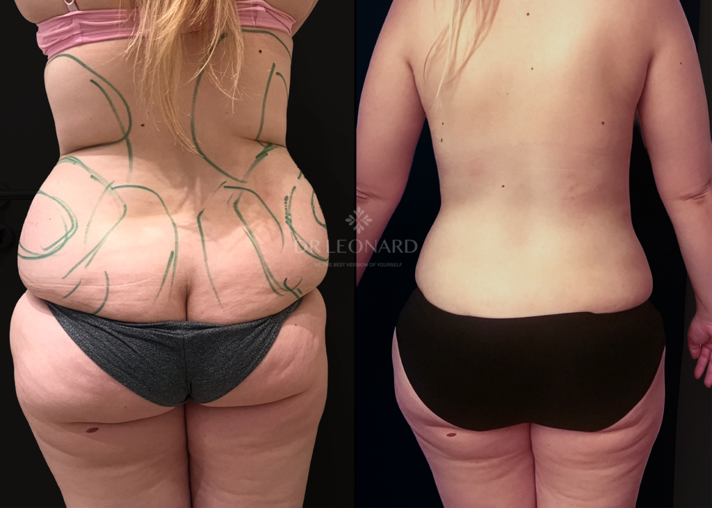 Liposuction Dubai back and flanks results