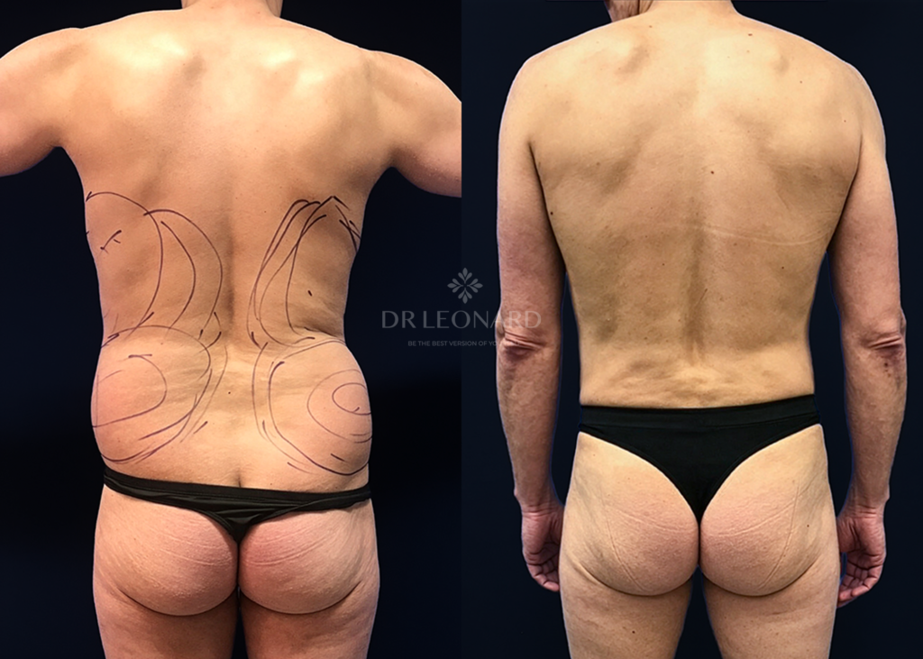 Male back and flanks liposuction dubai