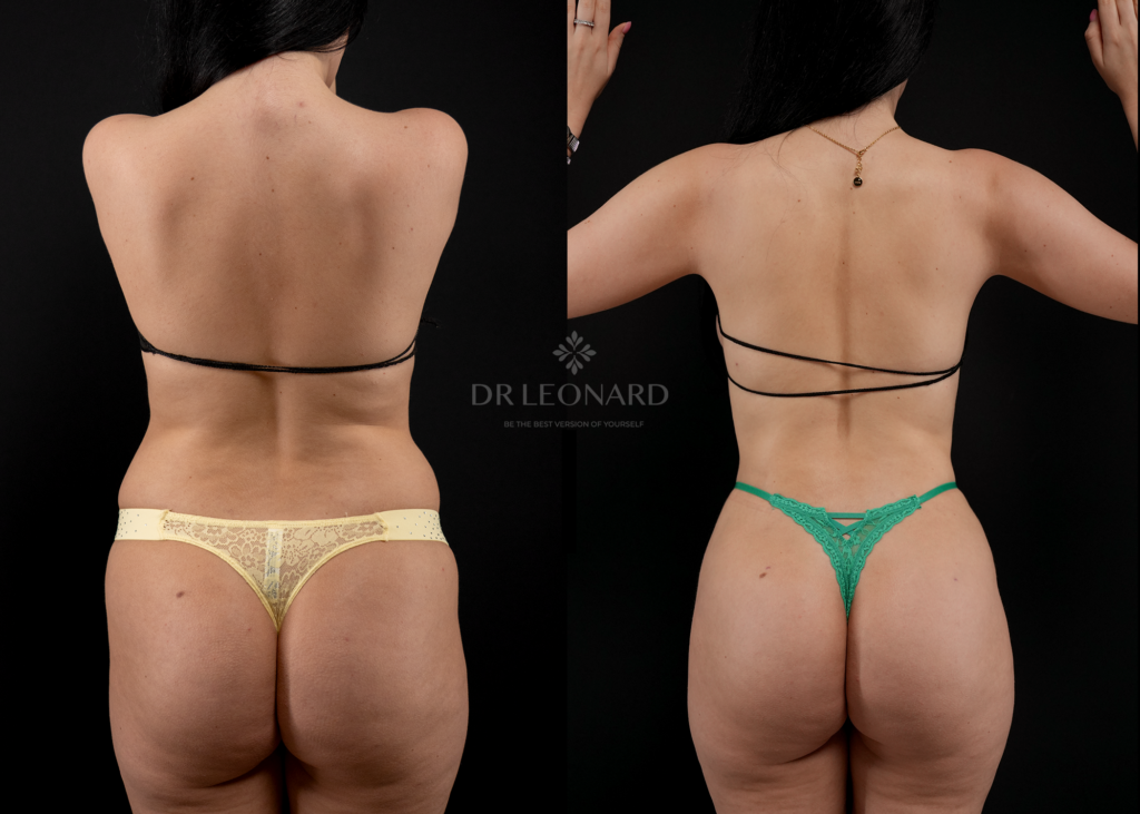 Before and after back liposuction Dubai
