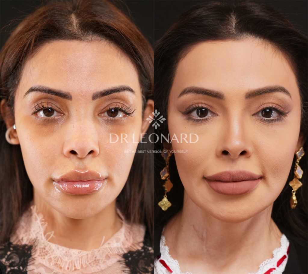Blepharoplasty in dubai before after result
