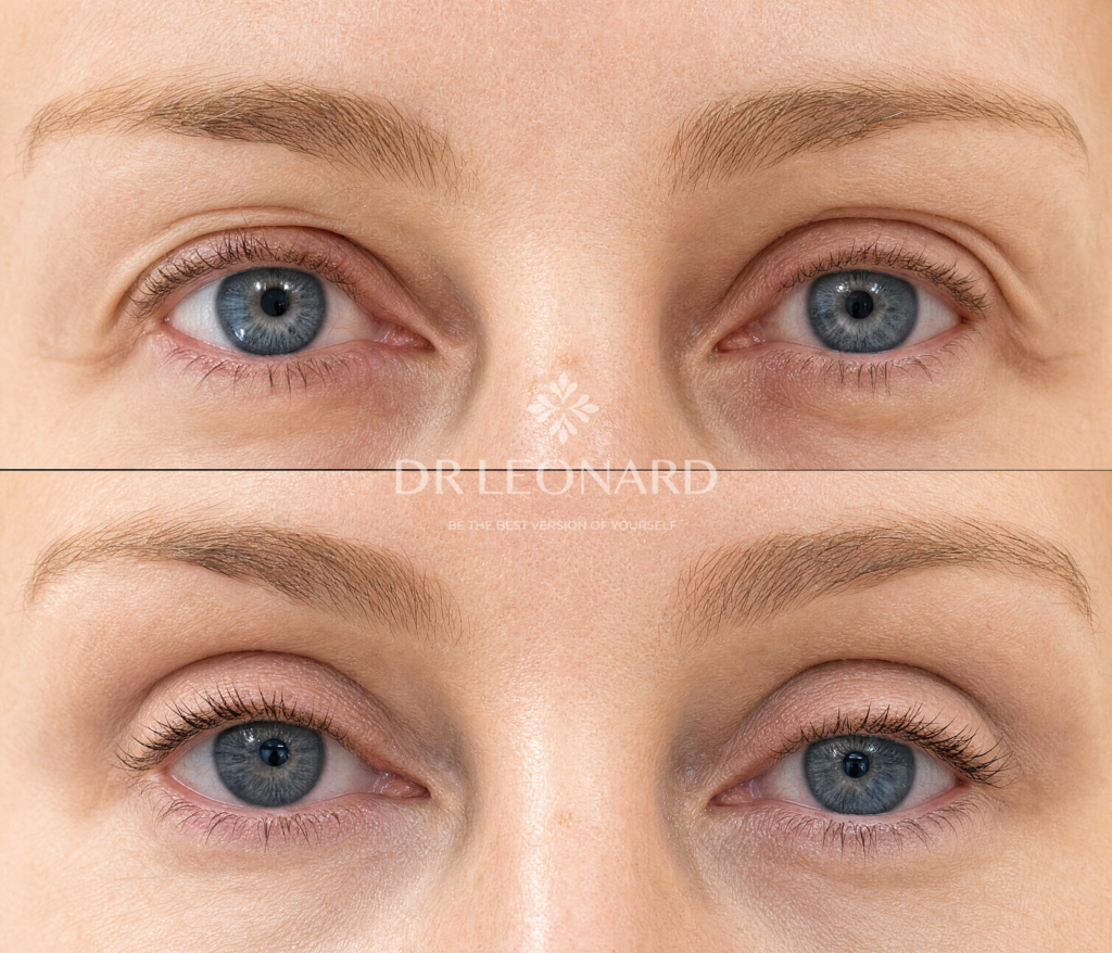 Blepharoplasty in Dubai Results