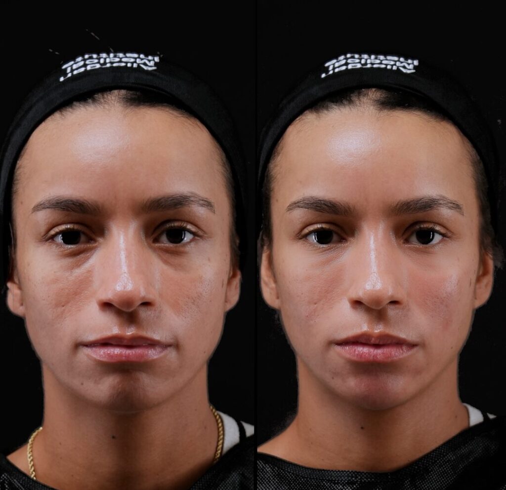 under eye fillers dubai cost