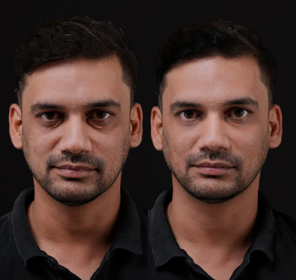 Under eye fillers in dubai results