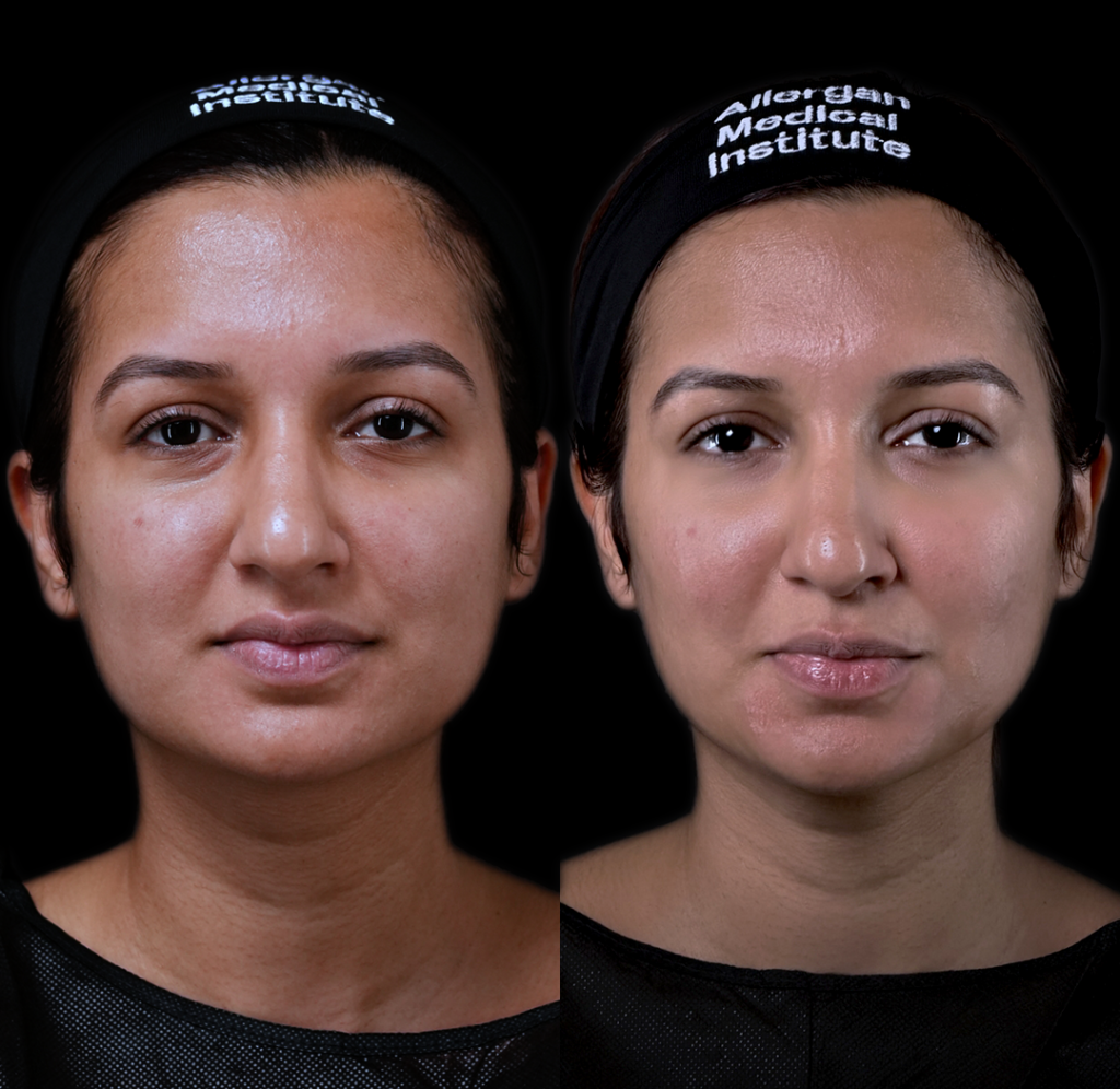 under eye fillers in dubai woman results