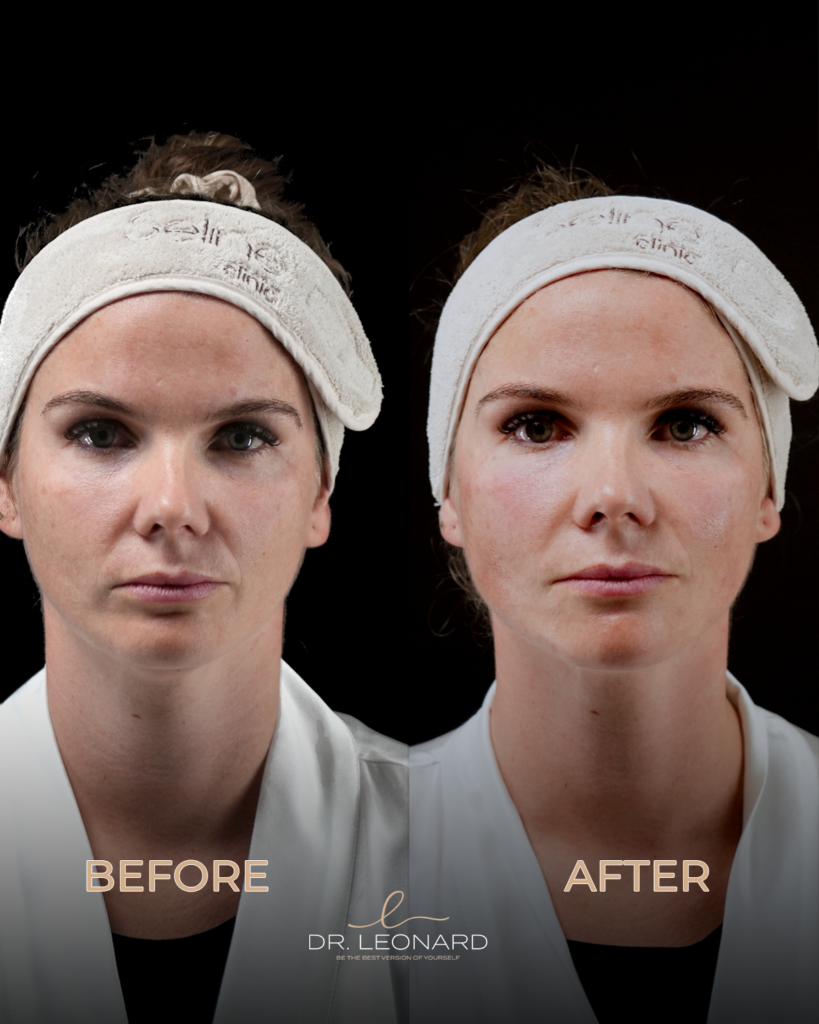 Dermal fillers Dubai before and after front view — natural results by Dr. Leonard Josipovic