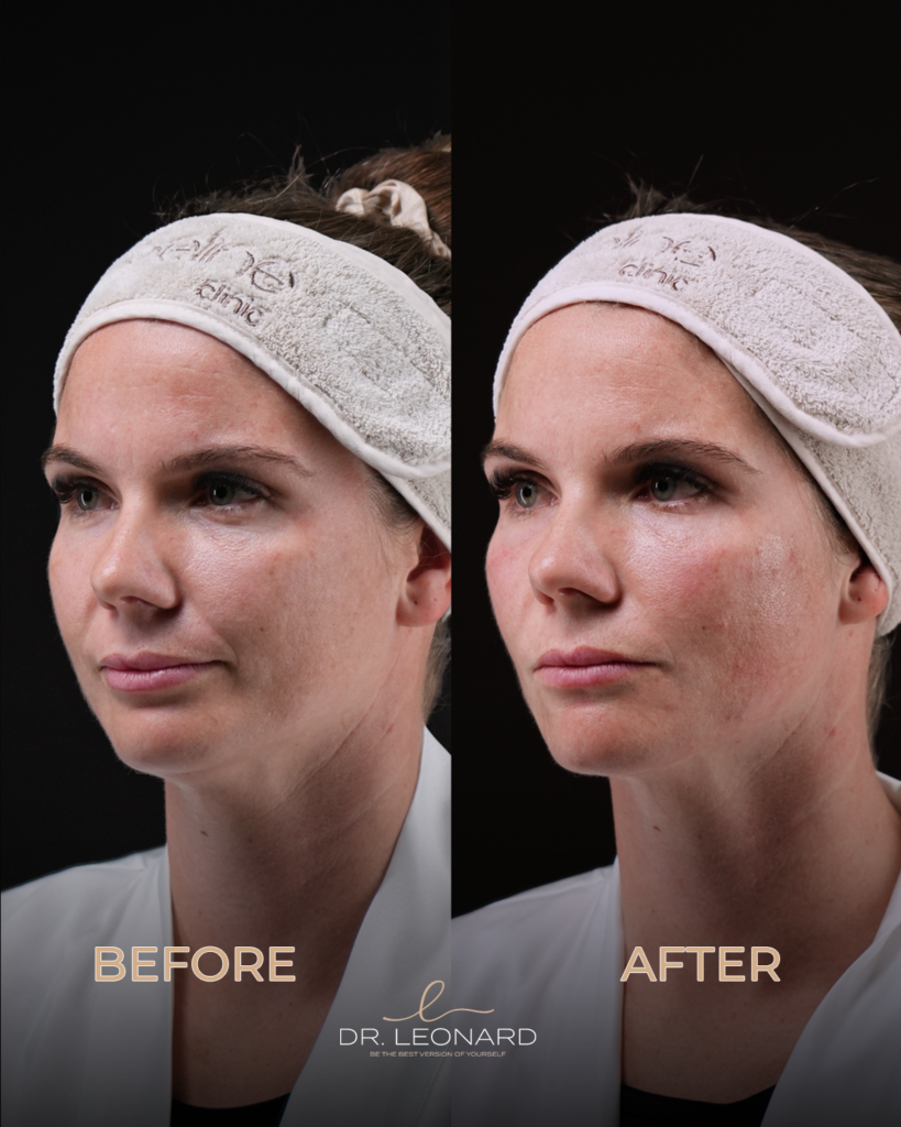 Dermal fillers Dubai before and after three-quarter view — volume enhancement by Dr. Leonard Josipovic