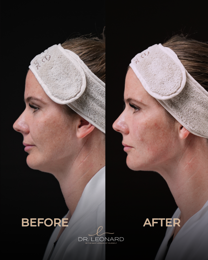 Fillers Dubai before and after side profile — facial contouring result by Dr. Leonard Josipovic