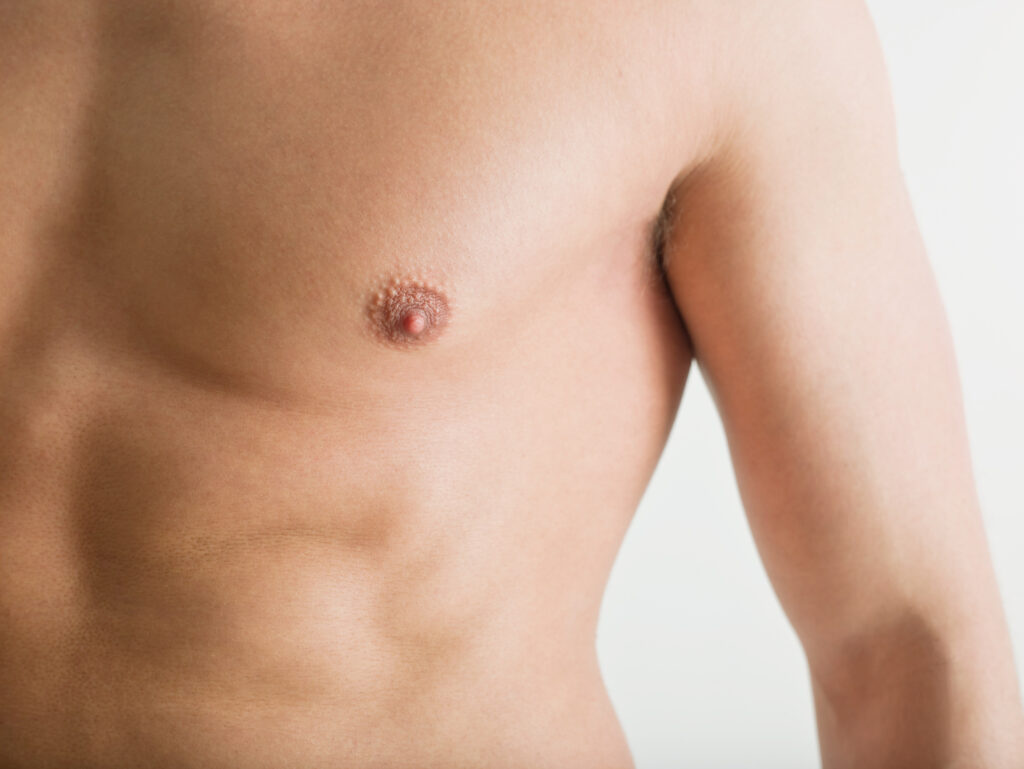 Gynecomastia in Dubai Surgery