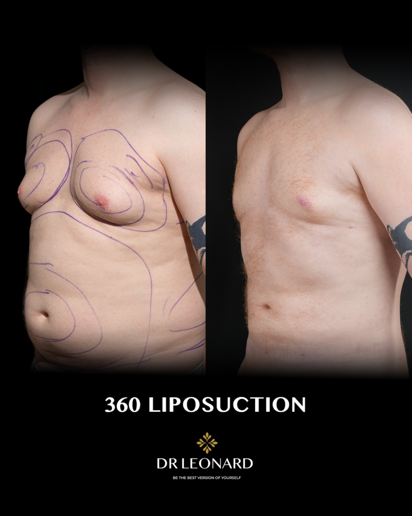 360 liposuction before and after Dubai — male patient 45 degree view, Dr. Leonard Josipovic