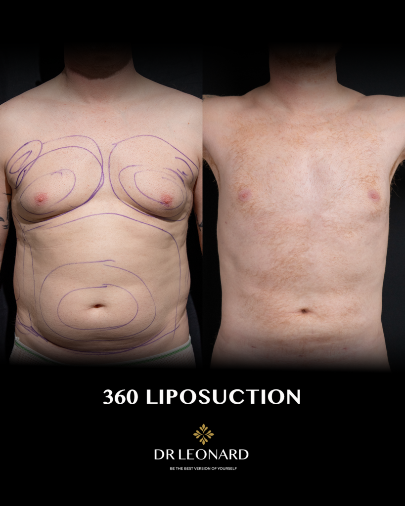 360 liposuction before and after Dubai — male patient front view, Dr. Leonard Josipovic