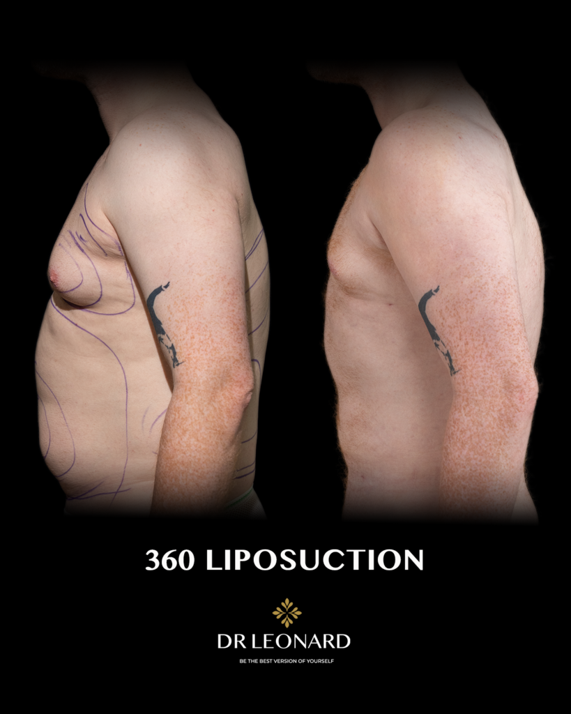 360 liposuction before and after Dubai — male patient side profile, Dr. Leonard Josipovic