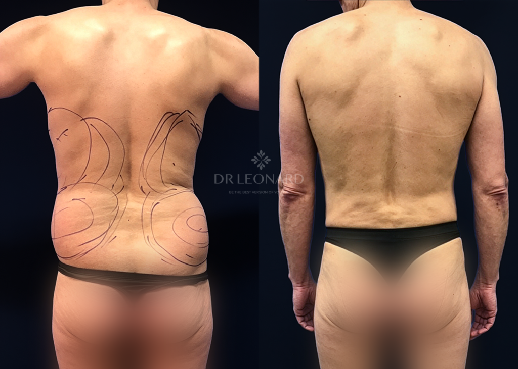 liposuction in dubai result