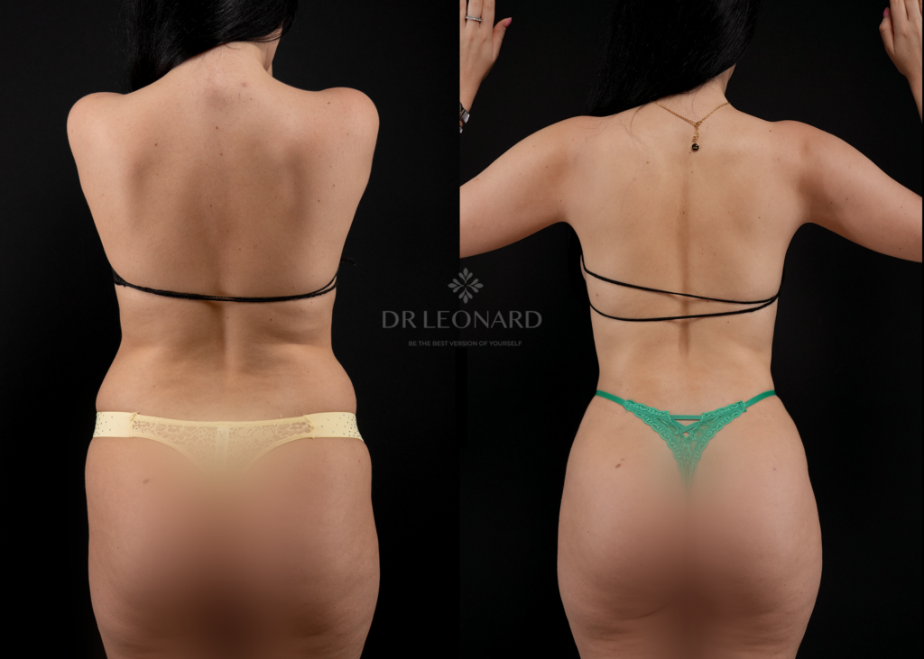 liposuction in dubai result before and after